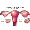 سندرم تخمدان پلی کیستیک و ناباروری