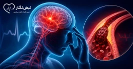 سکته مغزی ایسکمیک چیست؟ | علائم هشدار، درمان‌های طلایی و شانس بهبودی کامل